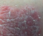 Comment soigner le psoriasis