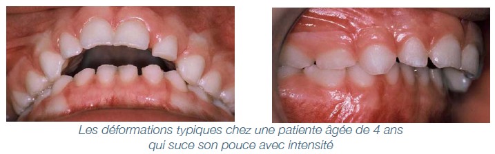 Dents déformées et sucette : tout savoir sur les effets de la tétine -  Dentiste pour Enfants