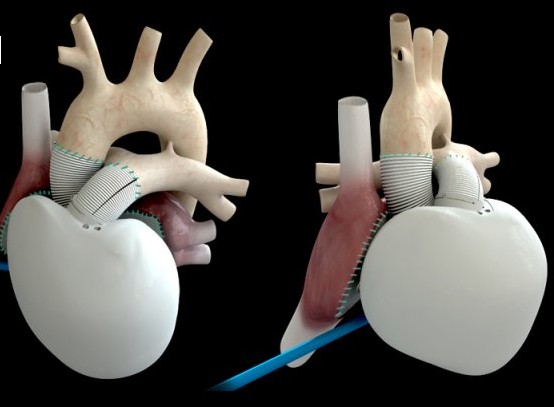 Le 3ème patient implanté du cœur CARMAT est rentré chez lui