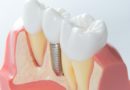 Implant dentaire : pour quel problème ?