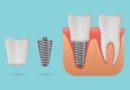Implant dentaire : comment se déroule la pose ?